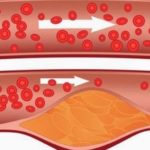 Sirup koji uklanja masnoću iz krvi…. Sirup koji uklanja masnoću iz krvi….