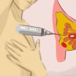 Doktor mi rekao da imam cistu na dojci-Napravila sam ovu smjesu Doktor mi rekao da imam cistu na dojci-Napravila sam ovu smjesu