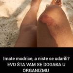 POJAVILE SU VAM SE MODRICE PO TIJELU, A NISTE SE UDARILI: Evo šta to može značiti, oprez ljudi, može biti JAKO OPASNO POJAVILE SU VAM SE MODRICE PO TIJELU, A NISTE SE UDARILI: Evo šta to može značiti, oprez ljudi, može biti JAKO OPASNO