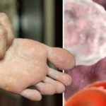 OTKRIJTE DA LI IMATE VISOK HOLESTEROL, POGLEDAJTE STOPALA: Ne morate da vadite krv, neočekivani simptom se krije na tijelu OTKRIJTE DA LI IMATE VISOK HOLESTEROL, POGLEDAJTE STOPALA: Ne morate da vadite krv, neočekivani simptom se krije na tijelu