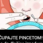 NE ČUPAJTE PINCETOM! Evo kako da dlačice iznad usana nestanu, SMJESA KOJA JE MNOGIM ŽENAMA POMOGLA (RECEPT) NE ČUPAJTE PINCETOM! Evo kako da dlačice iznad usana nestanu, SMJESA KOJA JE MNOGIM ŽENAMA POMOGLA (RECEPT)