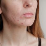 OD MASKE VAM ČESTO IZLAZE BUBULJICE ILI MODRICE? Dermatolozi Imaju Rešenje! EVO ŠTA TREBATE URADITI OD MASKE VAM ČESTO IZLAZE BUBULJICE ILI MODRICE? Dermatolozi Imaju Rešenje! EVO ŠTA TREBATE URADITI