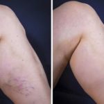 TIHI UBICA S PREDUMIŠLJAJEM: Duboka venska tromboza, neliječena, može da ima i FATALAN ISHOD! Evo koji su simptomi! TIHI UBICA S PREDUMIŠLJAJEM: Duboka venska tromboza, neliječena, može da ima i FATALAN ISHOD! Evo koji su simptomi!